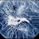 Choroideremia